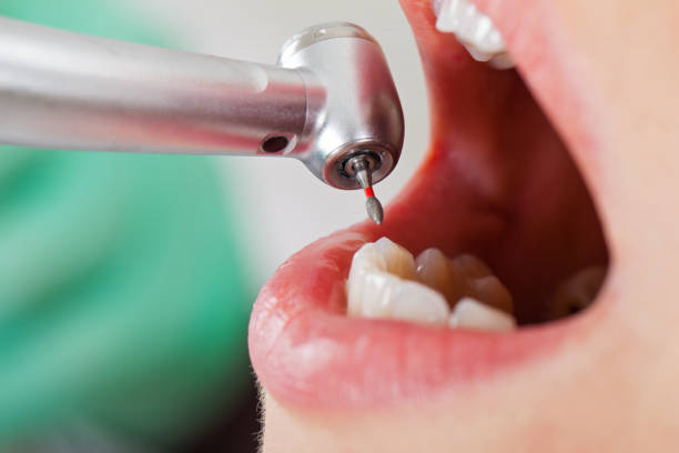 Best Emergency Dental Extractions in Crockett, CA